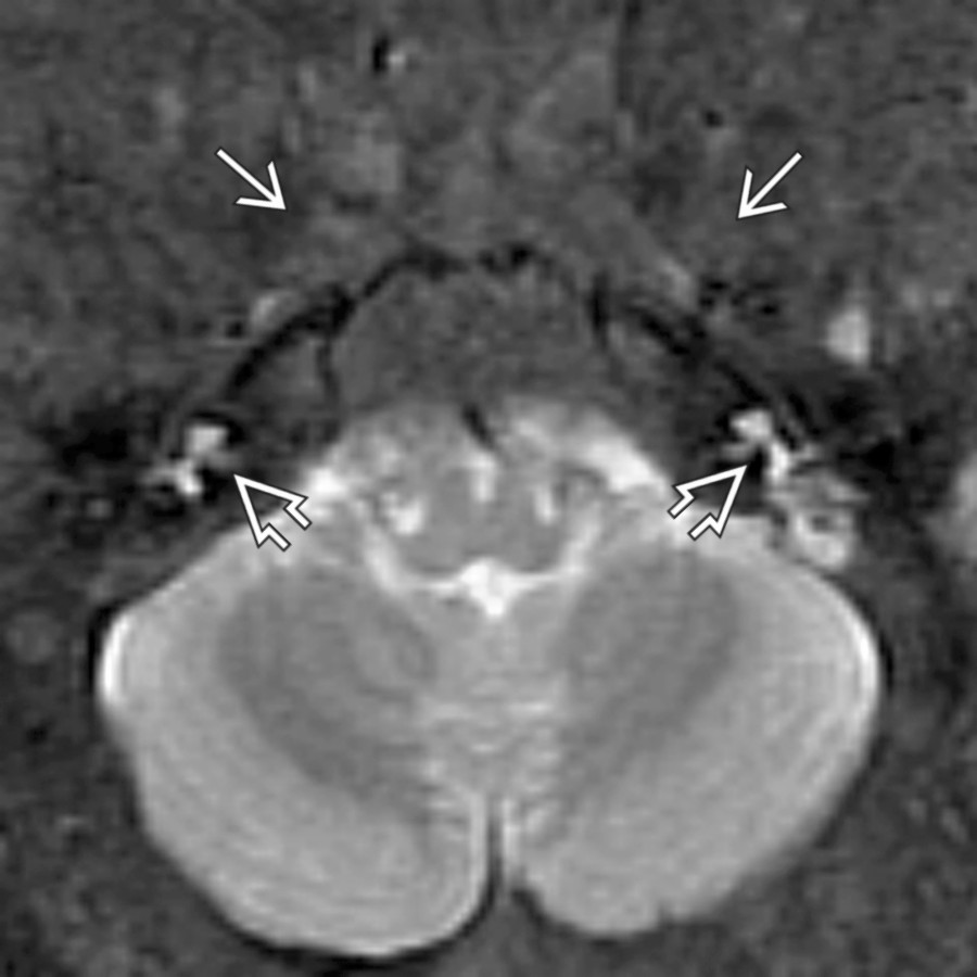 Axial T2WI MR in a teenage boy with polyostotic fibrous dysplasia and precocious puberty (McCune-Albright syndrome) shows severe involvement of the skull with fibrous dysplasia that appears hypointense
on T2WI. The IACs are small
due to progressive involvement of surrounding bone by fibrous dysplasia.