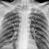 Frontal chest radiograph of an intubated patient demonstrates bulging of the tracheal wall
secondary to overdistension of the endotracheal tube cuff.