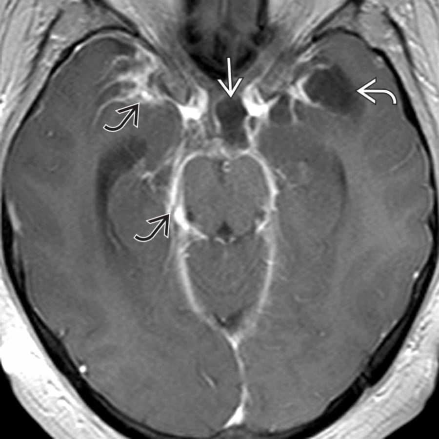 Axial T1 C+ MR demonstrates multiple cysts in the suprasellar cistern
and left sylvian fissure
. There is extensive leptomeningeal enhancement
in the basal cisterns and sylvian fissures. Cisternal NCC, also termed racemose (grape-like) if multiple cysts without scolex, may cause meningeal inflammation, communicating hydrocephalus, vasculitis, and infarcts.