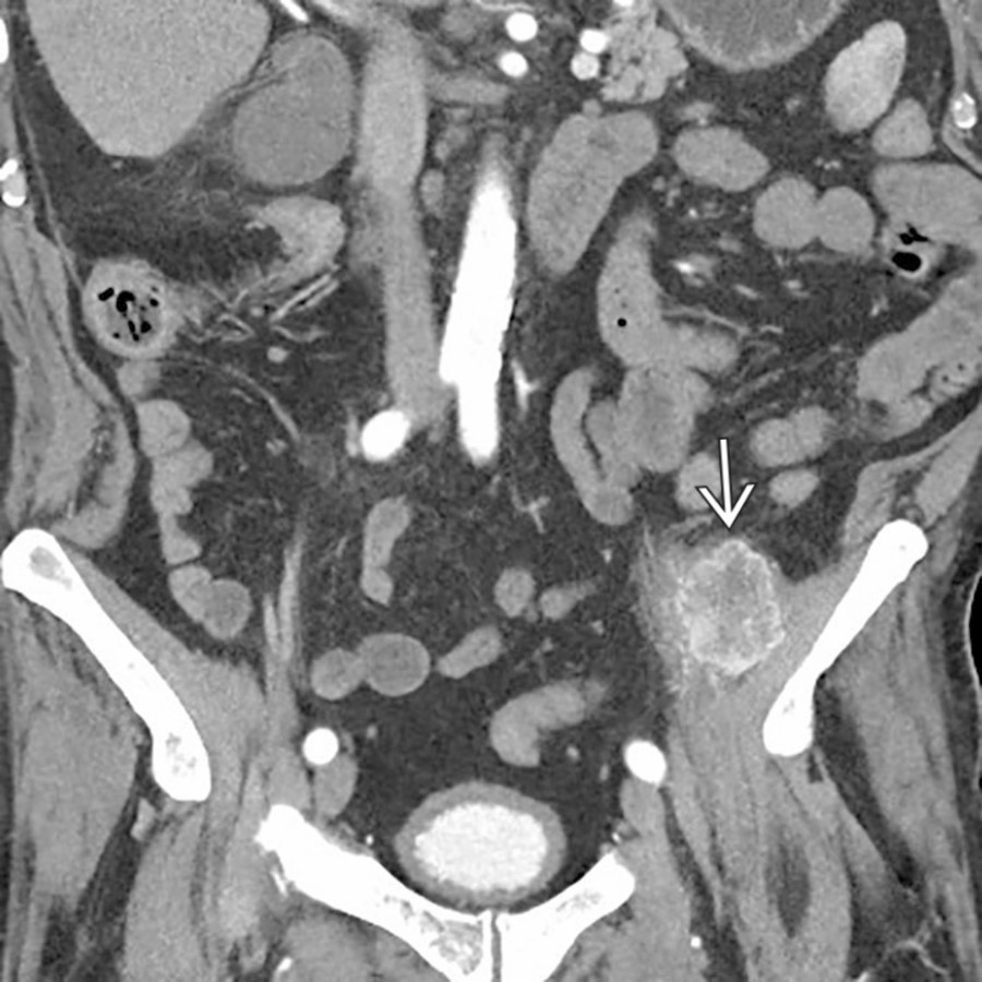 Coronal CECT shows an avidly enhancing mass
with central necrosis arising in the left iliopsoas muscle, representing a metastasis related to the patient's known renal cell carcinoma.