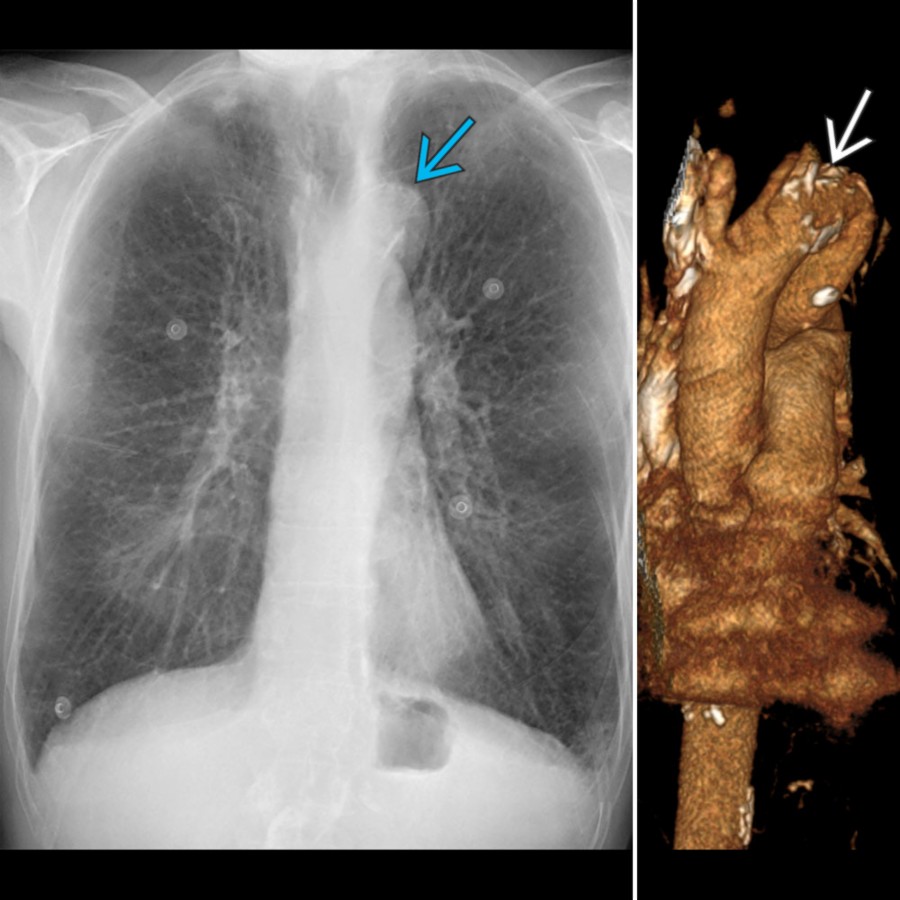 PA radiograph with bone subtraction (left) in a 67-year-old man shows abnormal elongation of the proximal descending thoracic aorta (DTA)
, which can be visualized
in coronal 3D volume-rendered image (right).