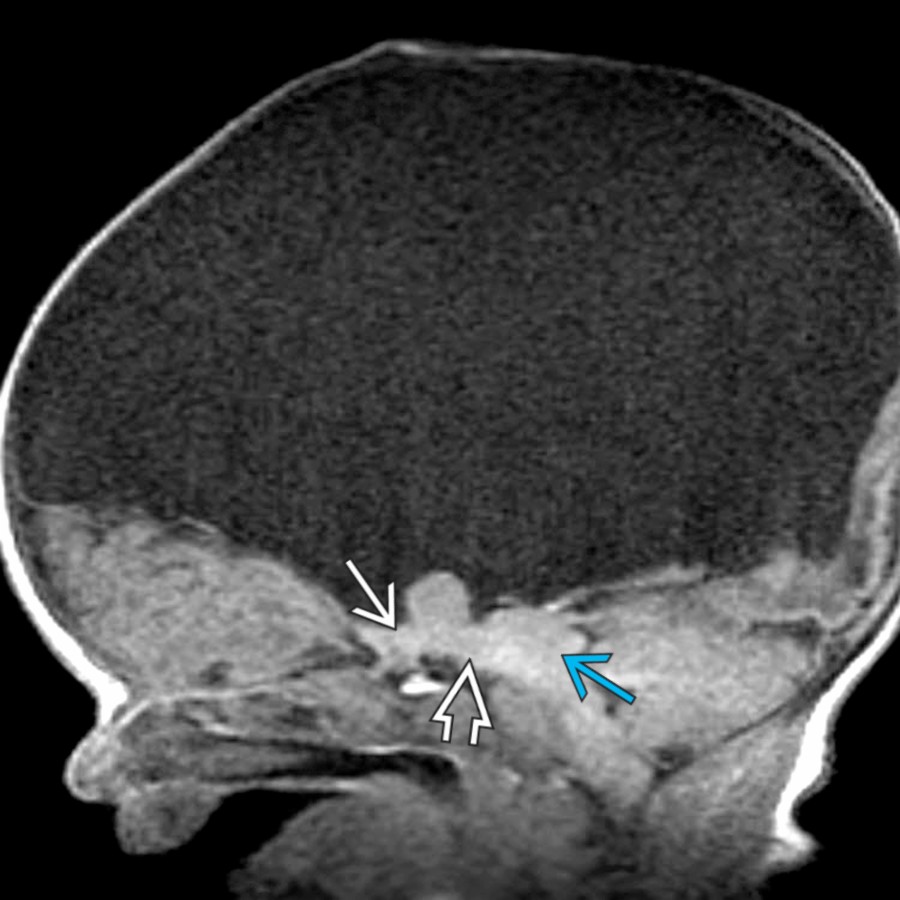 Sagittal T1WI MR in a 2 day old with aqueductal stenosis with effacement of the aqueduct
is shown. This patient also has diencephalic-mesencephalic dysplasia with incomplete separation of an enlarged massa intermedia from the midbrain
with thickening of the 3rd ventricular floor
.