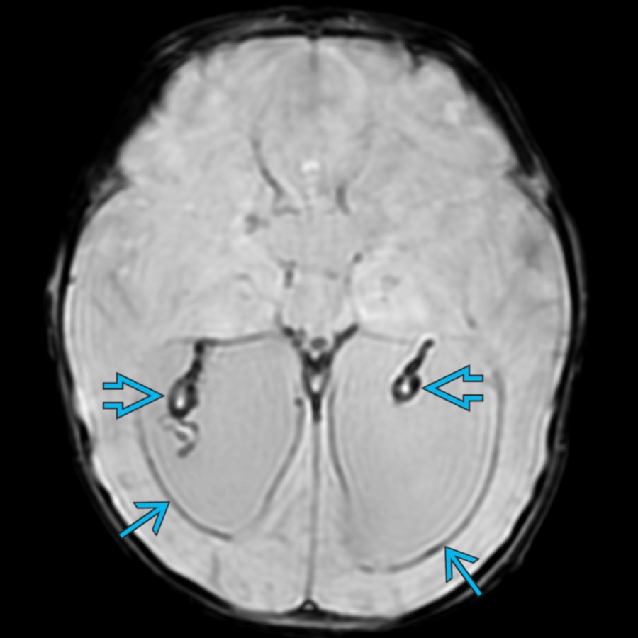 Axial SWI MR in a 3-month-old former premature infant with posthemorrhagic hydrocephalus shows signal loss along the ependymal margins
of the ventricles & choroid plexus
, consistent with prior IVH.