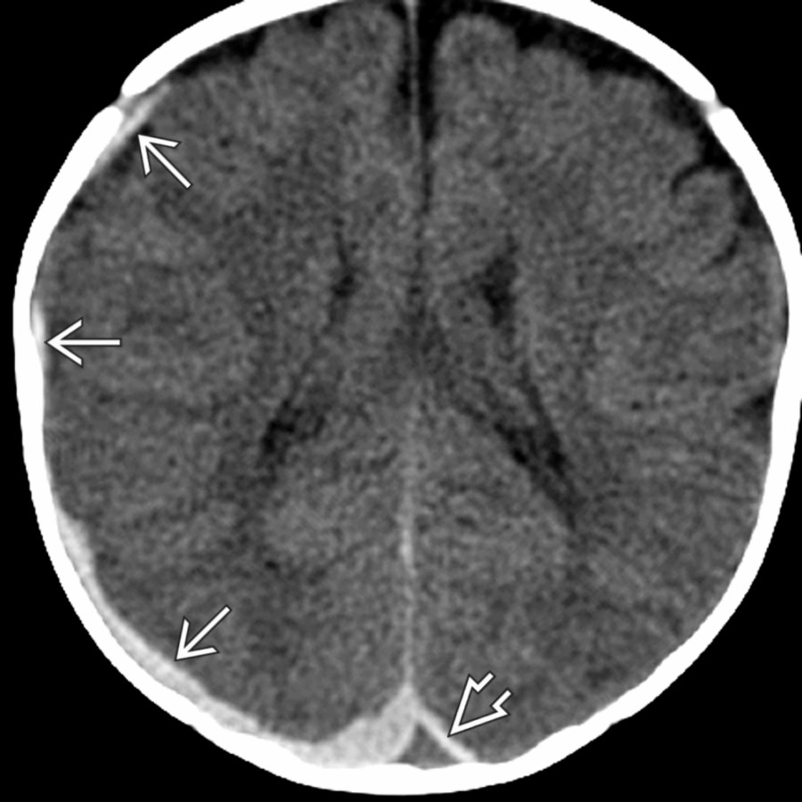 Axial NECT in a 3-month-old presenting with skull fractures shows subdural blood
overlying most of the right cerebral hemisphere & exerting mild mass effect on the underlying brain. Blood on either side of the sagittal sinus gives rise to the empty delta sign
, a mimic of sinus thrombosis.