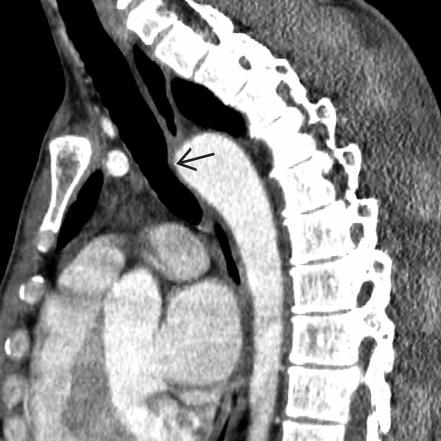 Sagittal chest CTA reformation in the same patient shows posterior tracheal indentation by the KD
. KD implies the presence of a ductus ligament contralateral to the arch and, hence, constitutes a vascular ring. KD predisposes to dysphagia when present (dysphagia lusoria).