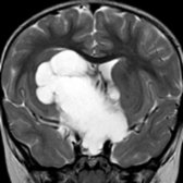 Coronal T2 MR in a 2 year old with a huge suprasellar mass shows multiple hyperintense cysts
. Adamantinomatous craniopharyngiomas typically present between 5-15 years in childhood and between 45-60 years in adults. They are the most common pediatric intracranial tumor of nonglial origin.