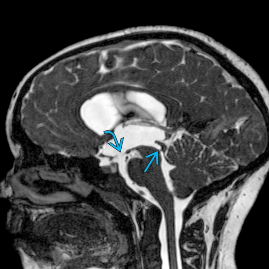 Sagittal FIESTA of a 5 year old with aqueductal stenosis secondary to a small obstructing web
is shown. This patient underwent a 3rd ventriculostomy
and is doing well. There are no other brain anomalies.