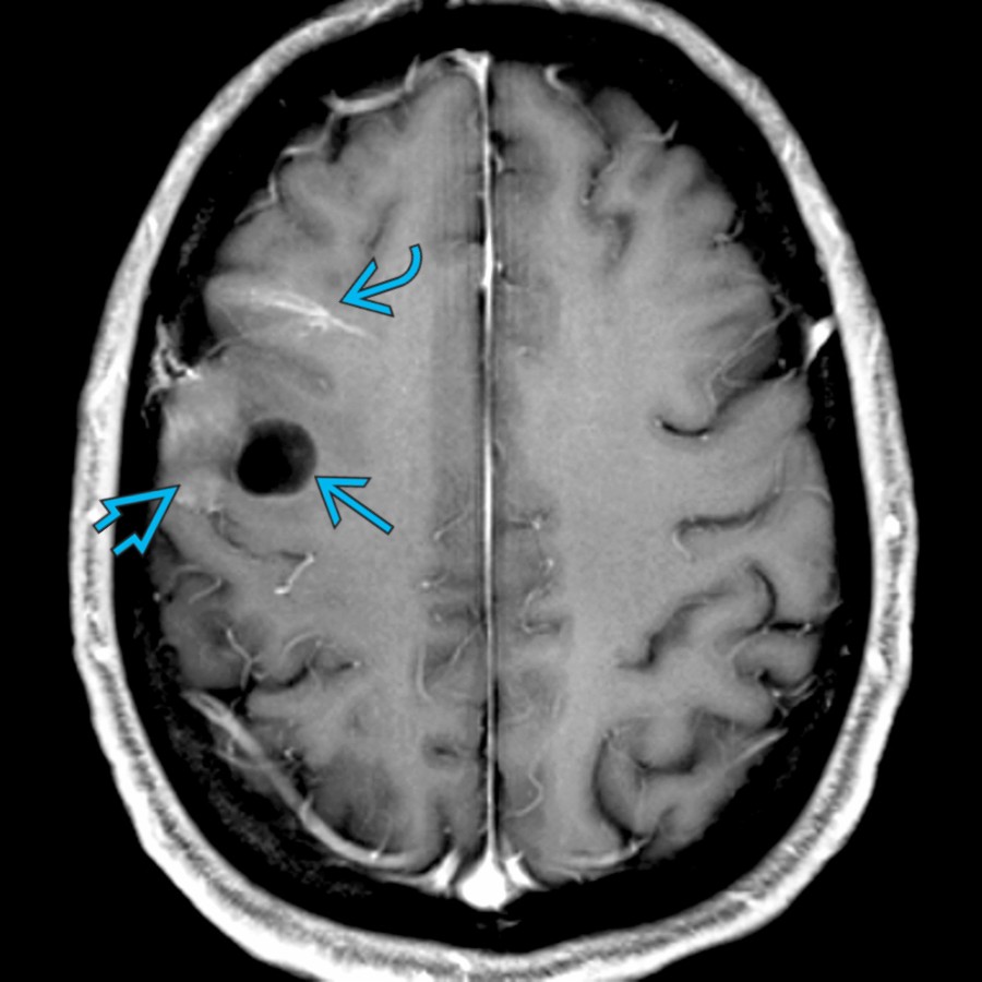 Axial T1 C+ MR shows a cyst
and heterogeneously enhancing nodule
involving the cortex. There is an incidental developmental venous anomaly
.