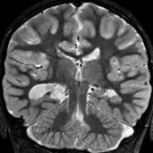 Coronal T2 MR in the same patient demonstrates associated left periventricular nodular gray matter heterotopia
and dysplastic inferior temporal lobe gray matter. Right choroid fissure cyst
is probably unrelated.