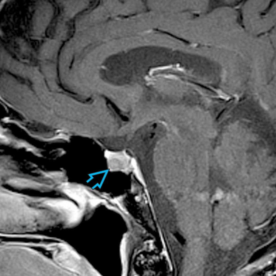 Sagittal T1 C+ FS MR in a 53-year-old man shows a mildly enlarged pituitary gland with a focal area of less enhancement
related to a microadenoma. Microadenomas are benign tumors of the adenohypophysis that are often seen best on dynamic CEMR.