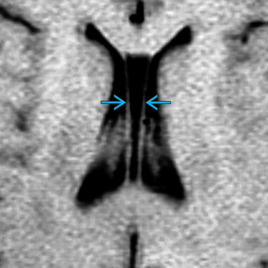 Axial T1 MR shows a small cavum septi pellucidi with cavum vergae
. Note the finger-like appearance of the CSF collection that lies between the frontal horns and bodies of the lateral ventricle.