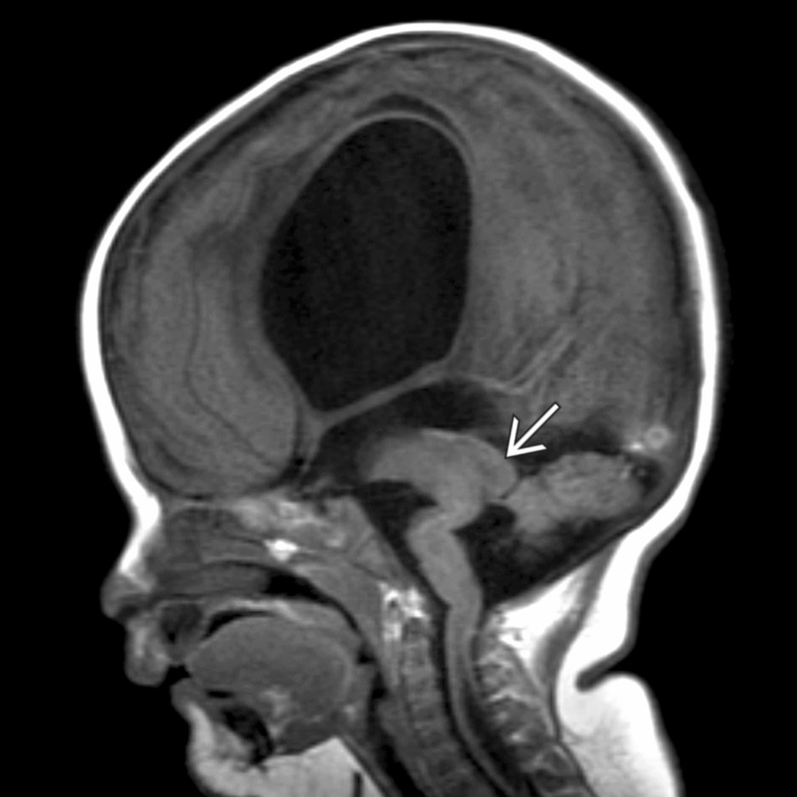 Sagittal T1WI MR in a patient with Walker-Warburg syndrome shows severe tectal dysgenesis
with aqueductal occlusion. Marked enlargement of the lateral ventricles more than the 3rd ventricle is present. A "zigzag" brainstem and very small cerebellum are characteristic of this syndrome.