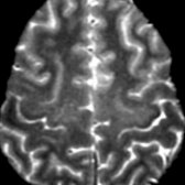 Axial T2WI MR in the same patient demonstrates bilateral low signal intensity in the precentral (motor) cortex
.