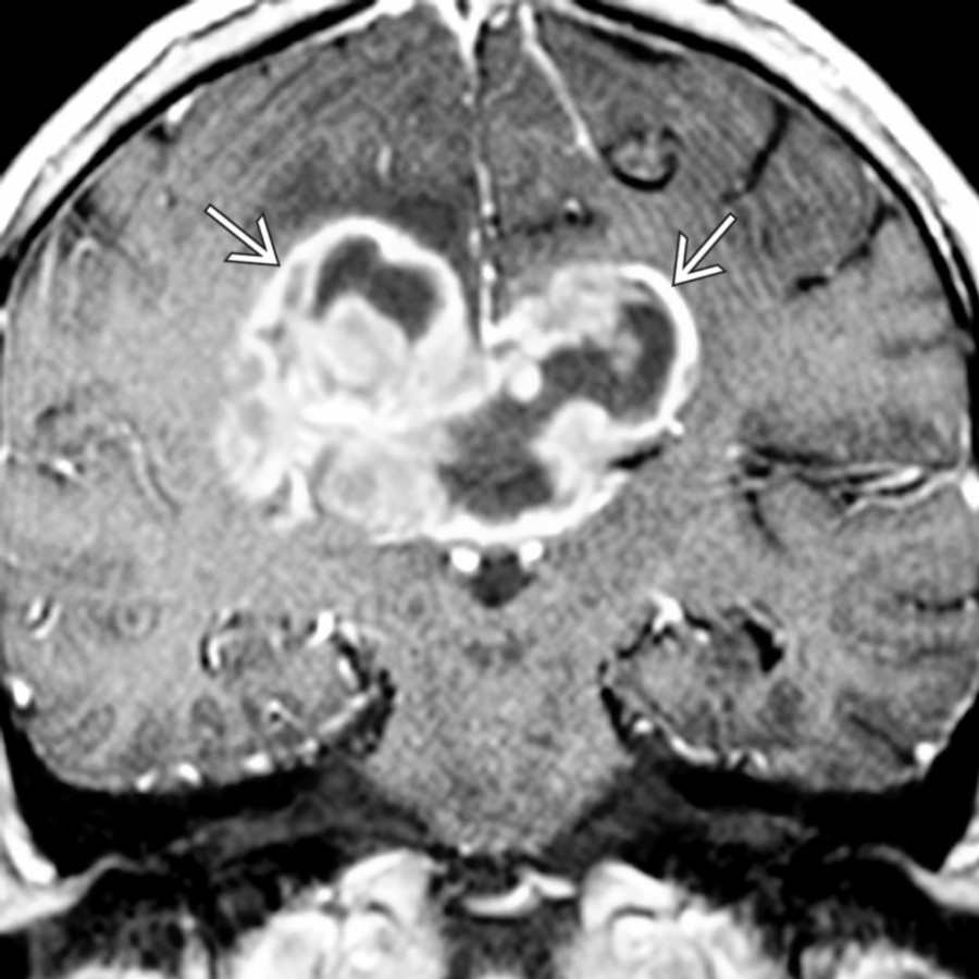 Coronal T1 C+ MR shows a classic "butterfly" glioblastoma multiforme of the corpus callosum
. Central necrosis with an irregular rind of enhancing tumor is typical.