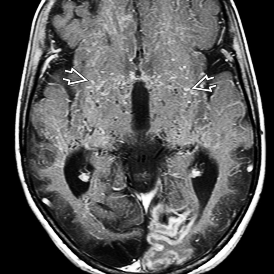 Axial T1 C+ FS MR in the same patient shows contrast in innumerable small arterial collateral vessels in the basal ganglia and deep white matter
, creating a puff of smoke appearance. (Courtesy H. Els, MD.)