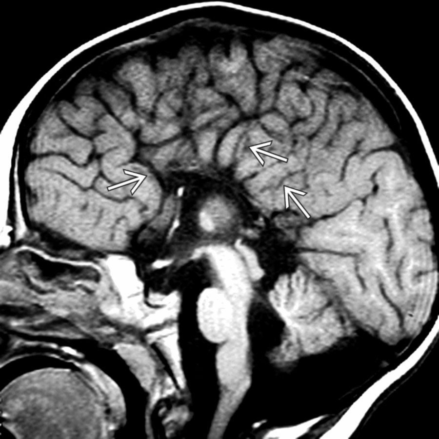 Midline sagittal T1 MR shows complete absence of the corpus callosum with associated absence of the cingulate gyrus. Note the radial arrangement of parasagittal gyri/sulci
, which point toward the 3rd ventricle.