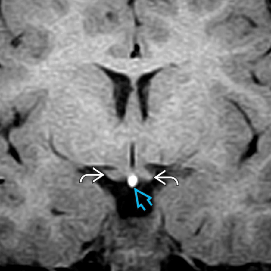 Coronal T1 MR depicts the ectopic posterior pituitary gland location at the median eminence
of the hypothalamus. A pituitary stalk is not visualized below the ectopic posterior pituitary. The septum pellucidum is present, and the optic tracts
are of normal size.