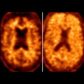 F-18 AV-45 (florbetapir) PET in a healthy control (left) shows nonspecific white matter uptake
and preserved gray matter-white matter differentiation. In a patient with AD (right), there is marked cerebral gray matter uptake
(Aβ deposition) with loss of gray matter-white matter differentiation. (Courtesy A. Ali, MD.)