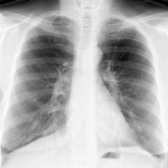 PA chest radiograph of a patient with asthma and allergic bronchopulmonary aspergillosis shows right basilar tubular opacities
corresponding to mucoid impaction in dilated airways.
