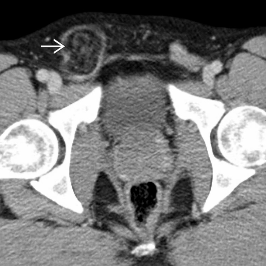 Axial CECT of a right inguinal hernia
contains herniated fat. The fat is somewhat "dirty" or infiltrated in appearance, suggesting incarceration or ischemia of herniated fat.