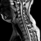 Sagittal T2WI MR in the same patient 1 year after treatment shows near-complete resolution of the T2 signal abnormality. Enhancement was no longer seen in the cervical cord. The cord lesions seen in NMO typically extend over 3 or more segments.
