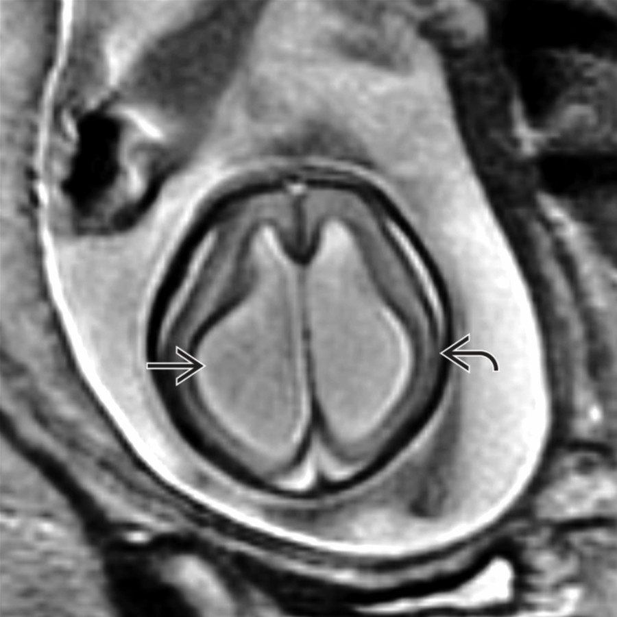 Axial T2 SSFSE MR in a fetus shows marked enlargement (> 15 mm) of the lateral ventricles
& thinning of the cerebrum
. With severe fetal ventriculomegaly (particularly in the setting of aqueductal stenosis), the septum pellucidum (& even the cerebral mantle) may become disrupted.