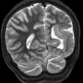 Coronal T2 MR in a 7-year-old with seizures shows extensive subependymal GM heterotopia
along the left lateral ventricular margin with overlying polymicrogyria
.