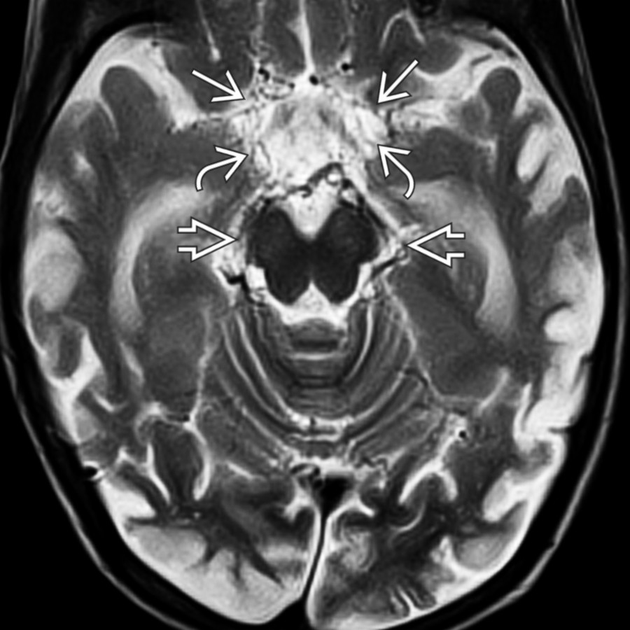 Axial T2WI MR in adult moyamoya shows attenuated, almost thread-like supraclinoid ICAs and middle cerebral arteries (MCAs)
with numerous tiny collateral vessels in the suprasellar cistern
and around the midbrain
. There is marked cortical atrophy along with enlarged temporal horns.