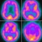 Axial reformatted FDG PET in the same patient shows diffuse decreased metabolic activity in bilateral frontal lobes
, striata (right > > left)
, thalami
, and midbrain
.