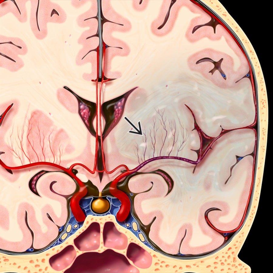 Coronal graphic illustrates left M1 occlusion. Proximal occlusion affects the entire middle cerebral artery (MCA) territory, including the basal ganglia (perfused by lenticulostriate arteries
). Acute ischemia is often identified by subtle loss of the gray matter-white matter interfaces with blurring of the basal ganglia and an insular ribbon sign on the initial CT.