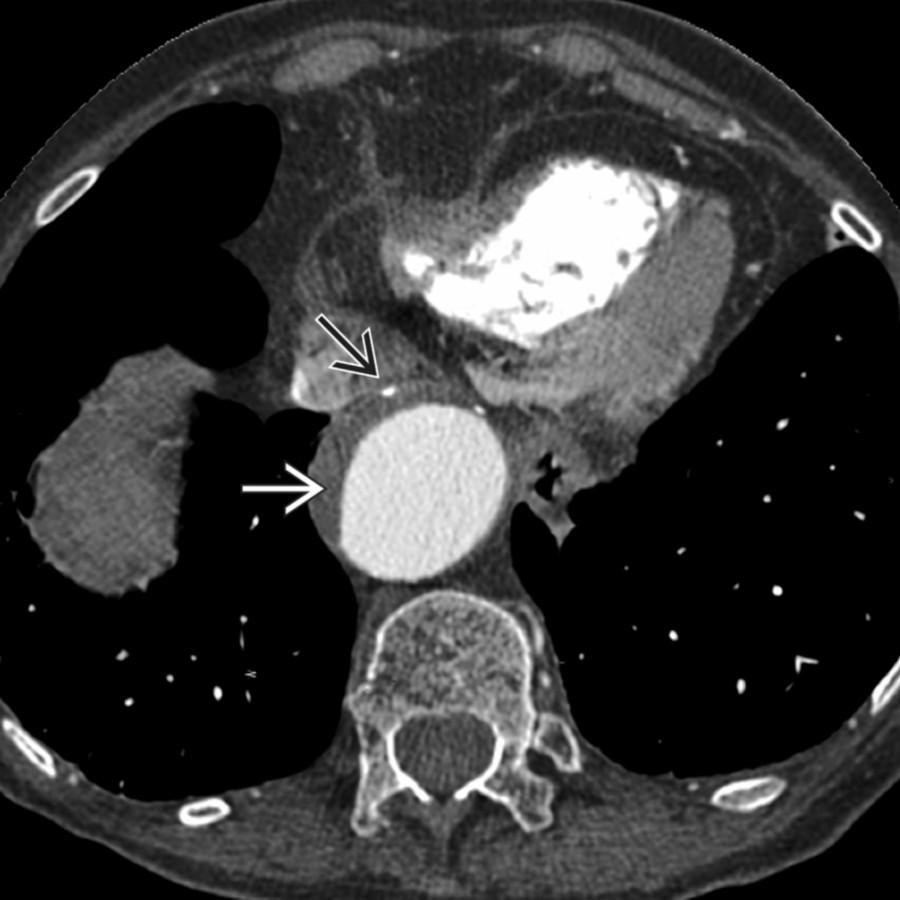 Axial CECT shows intimal disease with mural thrombus
and intimal calcifications
. This patient had a diffusely dilated and tortuous aorta.