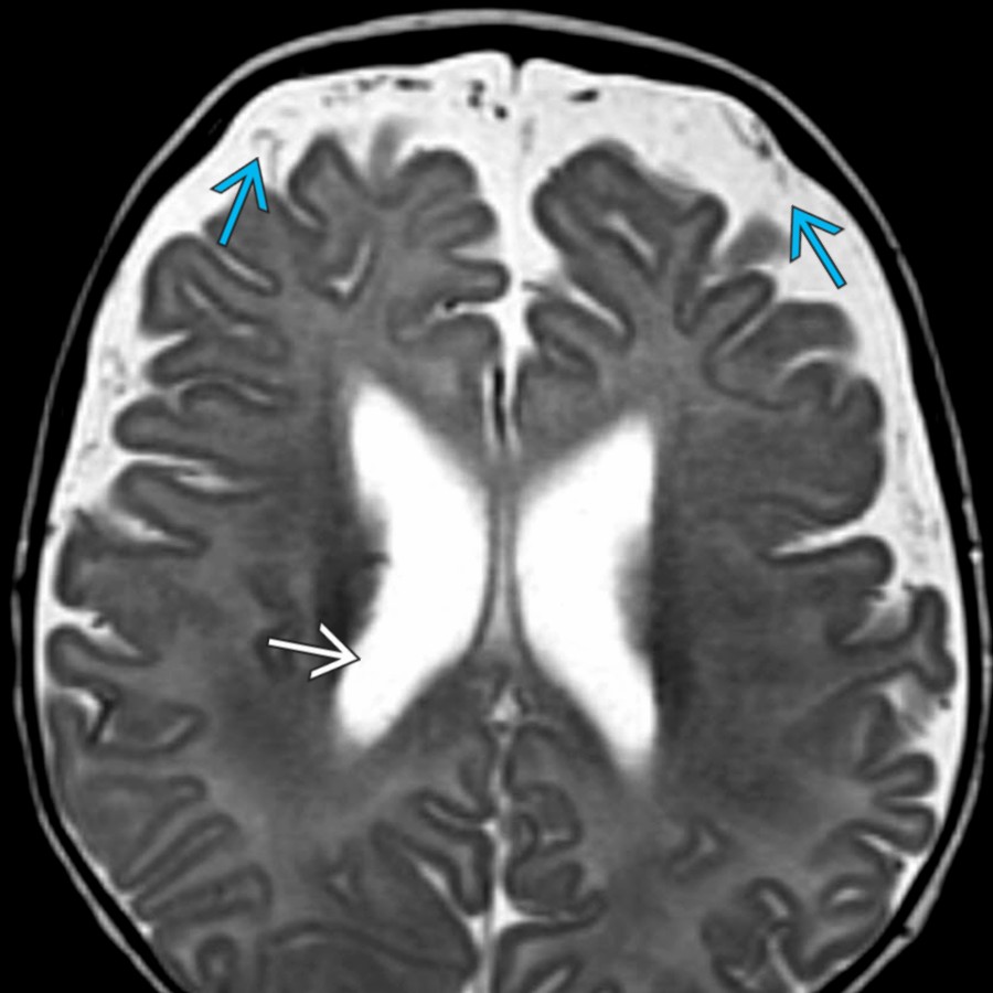 Axial T2 MR in a 6-month-old boy with enlarged SAS shows vessels
coursing through the SAS. Note the lack of mass effect on the underlying brain parenchyma. There is mild enlargement of the lateral ventricles
, a common finding in benign enlargement of the SAS.