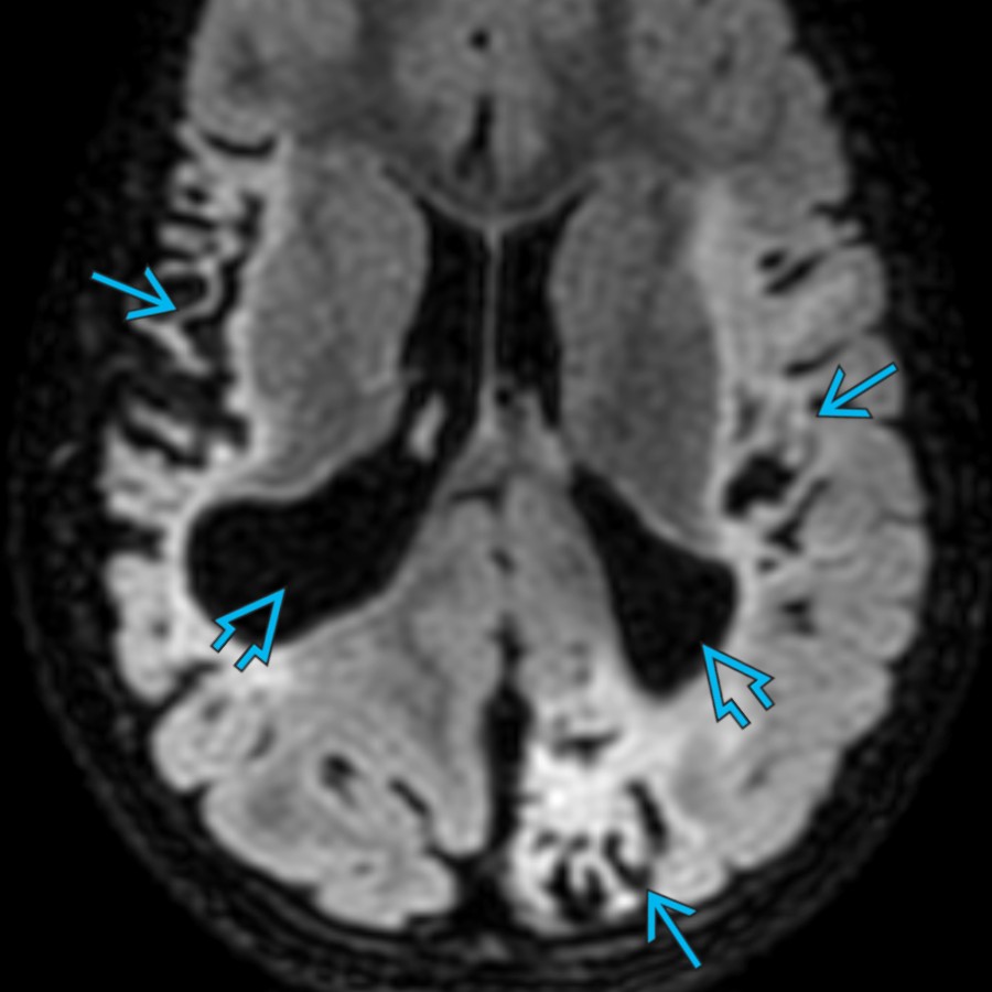 Axial FLAIR MR in a 4-year-old with a history of perinatal hypoxic-ischemic injury (HII) shows extensive areas of cortical encephalomalacia
. Note the localized areas of ventriculomegaly
due to overlying brain volume loss.