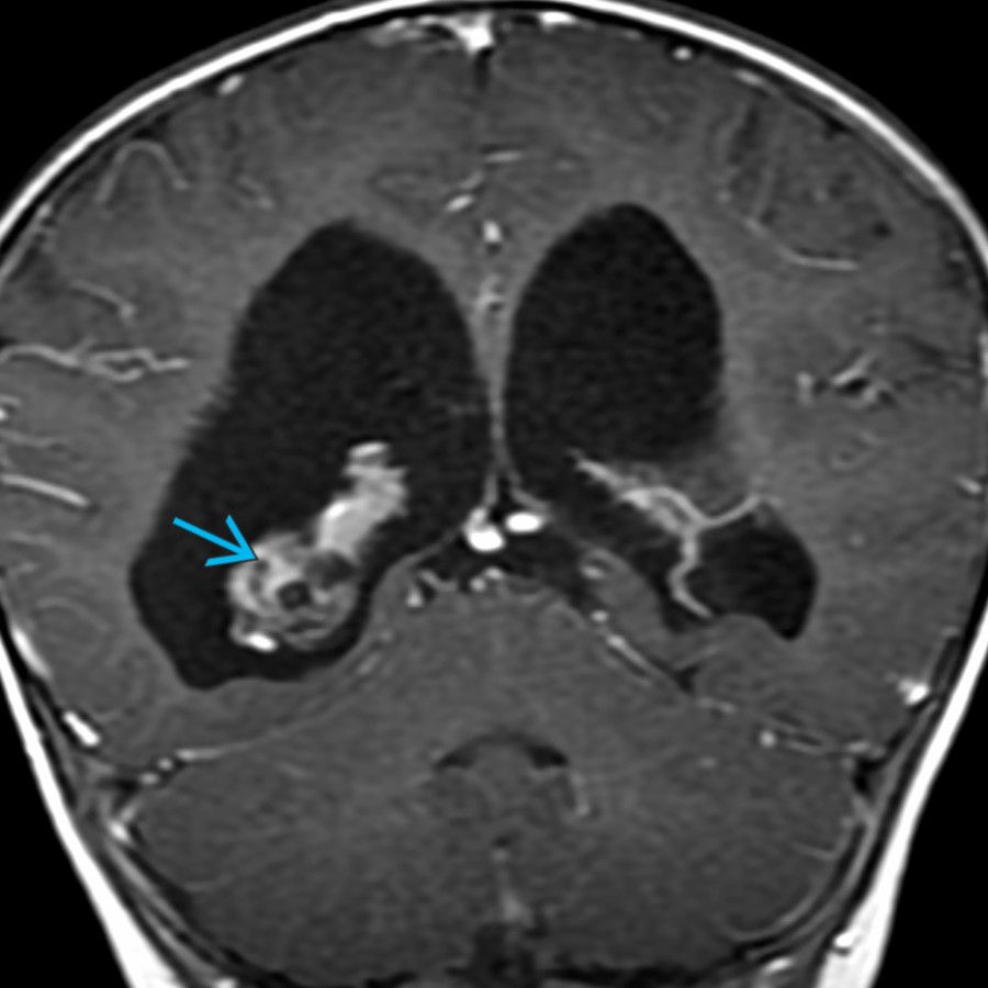 Coronal T1 C+ MR in a 1-year-old with a choroid plexus papilloma shows an enhancing mass
in the right choroid plexus. The lateral ventricles are enlarged without evidence of obstruction. Hydrocephalus in this case is due to overproduction of CSF by the tumor.