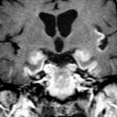 Coronal T1 C+ MR shows abnormal gyriform enhancement in the medial temporal lobes and left insula
. The more typical patchy enhancement pattern of limbic encephalitis is seen in the hippocampi bilaterally.