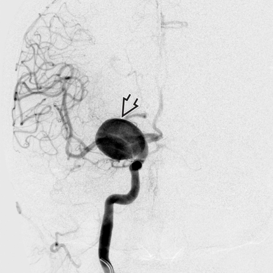 AP DSA of internal carotid artery injection shows a giant internal carotid artery aneurysm
, > 2.5 cm, in this 63-year-old woman. Saccular aneurysms are the 3rd most common suprasellar mass in adults. The enhancement pattern is variable, depending on the patency of the aneurysm.