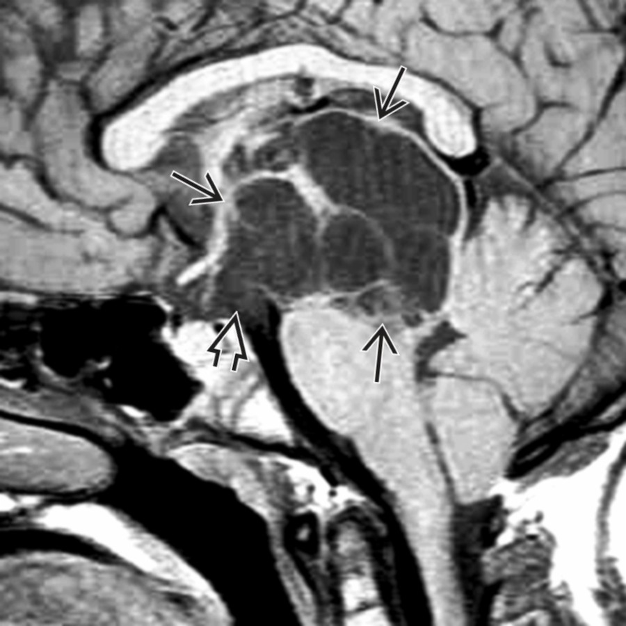 Sagittal T1WI MR in a 15-year-old with headaches shows multiple CSF-like cysts in the hypothalamus, thalamus, and midbrain
that bulge into the suprasellar subarachnoid space
.