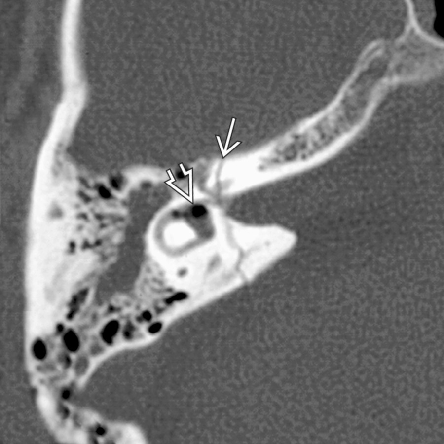 Axial bone CT shows a transverse otic capsule violating T-bone fracture
with associated pneumolabyrinth and gas in the vestibule
and lateral SCC.
