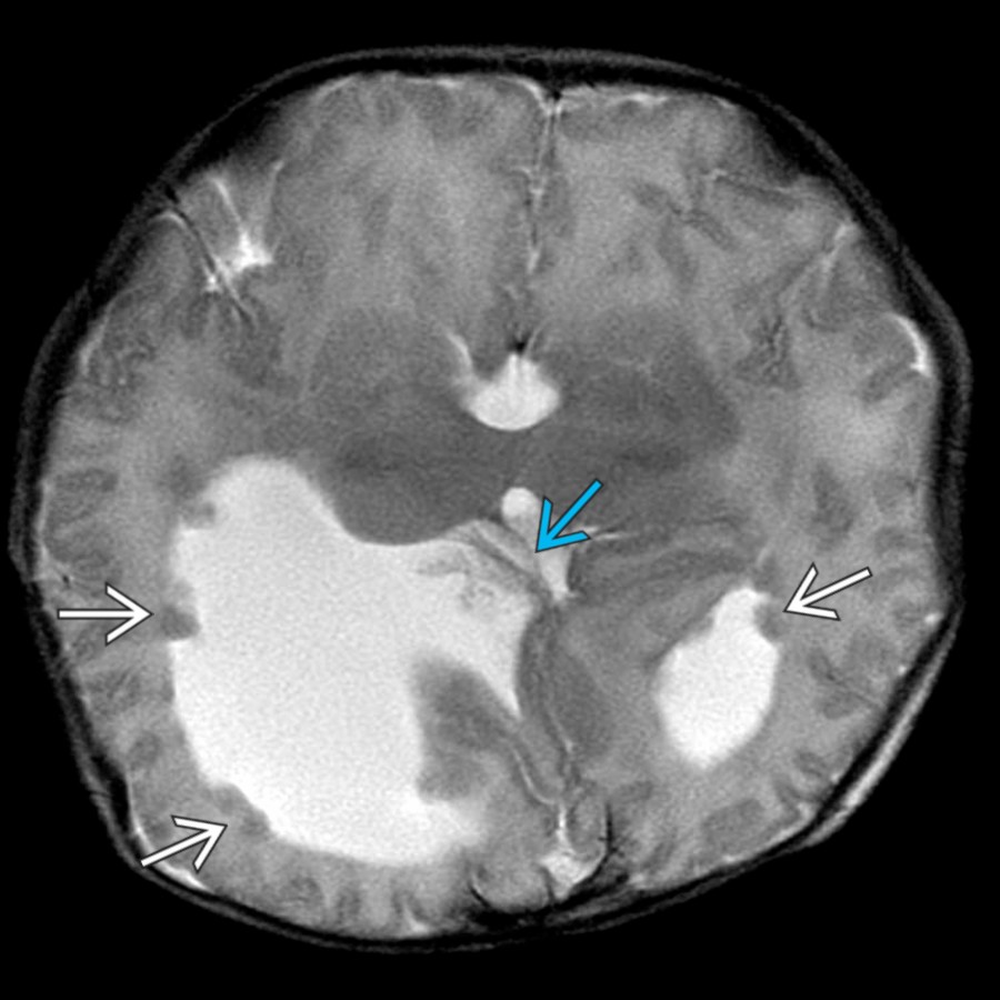 Axial T2WI MR in the same patient demonstrates dilation of the lateral and 3rd ventricles with right ventricular diverticulum
and multiple subependymal gray matter heterotopias
.