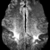 Axial DWI MR shows increased signal involving subcortical white matter of both precentral (motor) gyri, extending caudally into CSTs (not shown). These findings are typical for ALS.