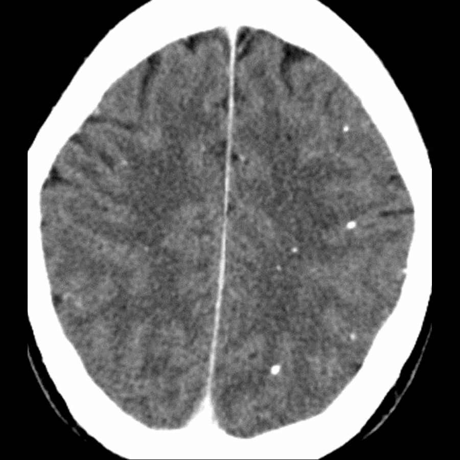 Axial NECT in a patient with seizures shows multiple scattered, hyperdense, left more than right frontoparietal lobe calcifications. Perilesional gliosis contributes to the epileptogenicity of nodular calcified NCC.
