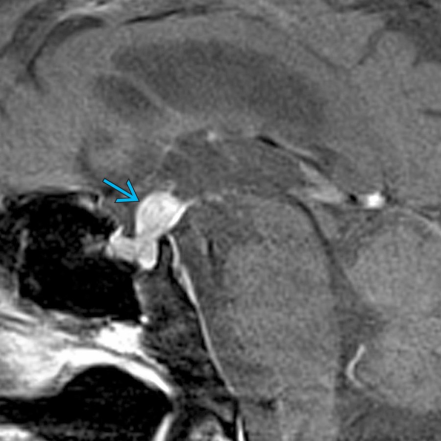 Sagittal T1 C+ MR shows a diffusely enhancing infundibular mass
in this 68-year-old woman with hypopituitarism. Pituicytomas are WHO grade I tumors with nuclear expression of TTF-1 that arise in the neurohypophysis or infundibulum.