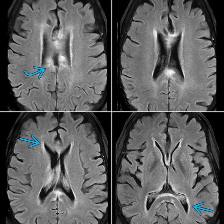 Axial FLAIR MR in the same patient 7 days following placement of the shunt catheter demonstrates ill-defined hyperintensities in the body of the CC
as well as in the periventricular white matter
. Note decompressed lateral and 3rd ventricles.