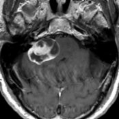 Axial T1 C+ MR demonstrates a mixed solid and cystic enhancing mass in the right CPA cistern
. A small amount of tumor extension is visible extending into the IAC
.