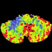 Section through the cerebellar hemispheres in the same patient shows acutely ↓ CBF in the right cerebellar hemisphere
. As afferent input to the cerebellum is reduced, regional metabolism diminishes & CBF falls. This is hyperacute CCD.