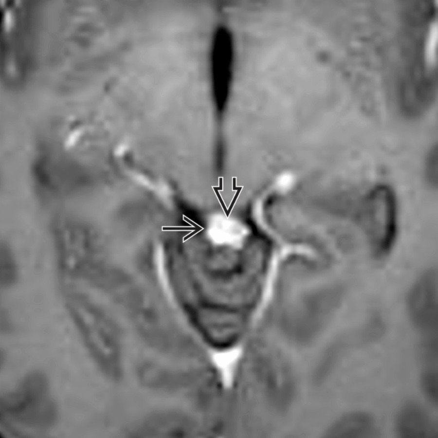 Axial T1 C+ MR in an NCC patient shows a ring-enhancing cyst
with tiny scolex
enhancement in the quadrigeminal cistern posterior to the midbrain.