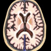 Axial graphic depicts a normally aging brain in an 80-year-old patient. Note the widening of sulci & ventricles in the absence of any brain parenchymal abnormalities.