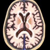 Axial graphic depicts a normally aging brain in an 80-year-old patient. Note the widening of sulci & ventricles in the absence of any brain parenchymal abnormalities.
