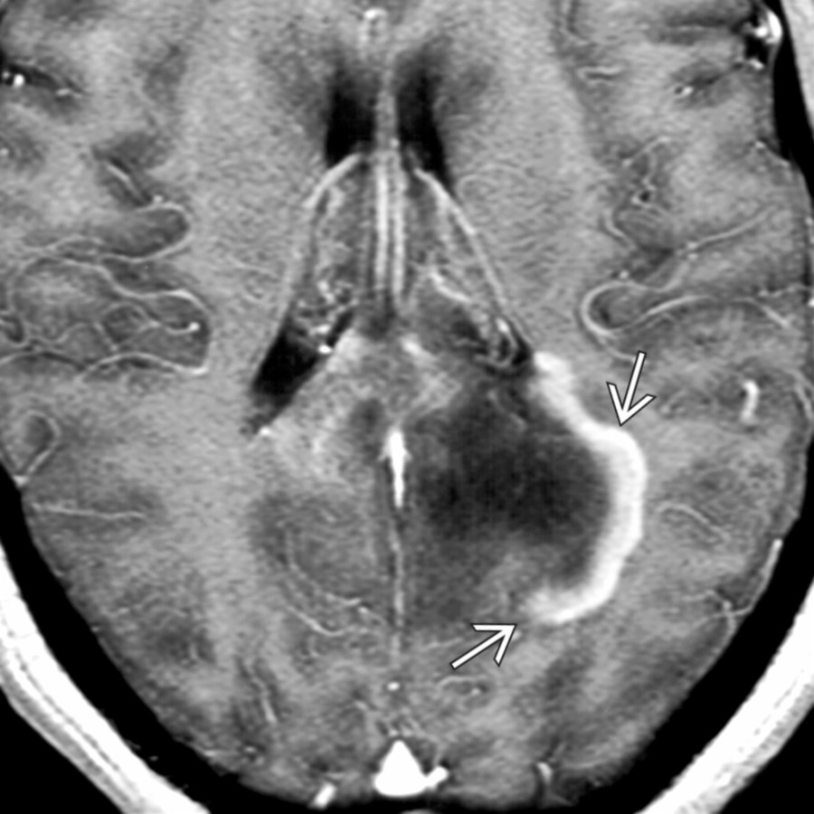 Axial T1 C+ MR shows a characteristic tumefactive multiple sclerosis (MS) plaque with irregular, thick partial ring enhancement and mass effect
. These lesions may cross the corpus callosum and mimic tumors.