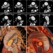 CT images (top) show a linear filling defect and contour irregularity in the ascending and transverse aorta. Note undermined edges of the tear
and the bulging wall
. 3D images (bottom) show a longitudinally oriented limited tear
seen from the outside (left) and inside (right). (Courtesy Chin et al.)